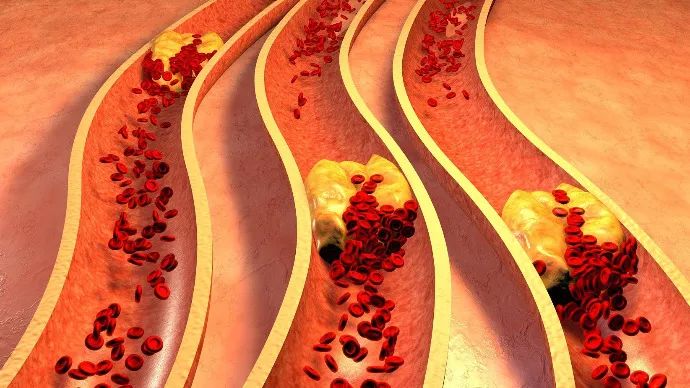 高血脂危害大 高血脂危害大