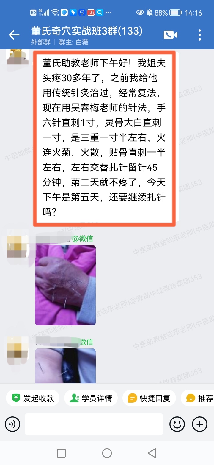 董氏奇穴实战班反馈：姐夫头痛三十多年经常反复，以针方调理好了！