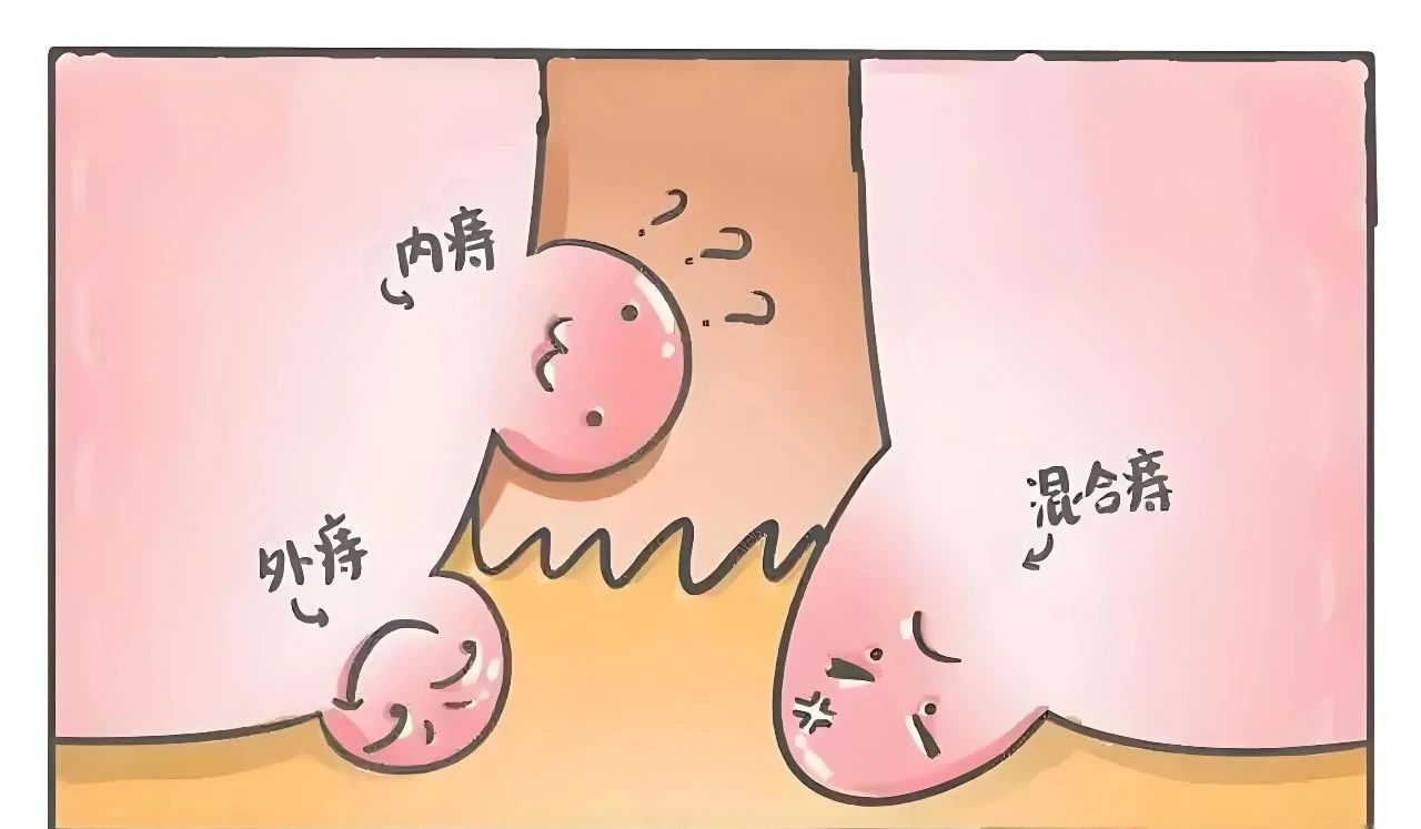 根除痔疮蕞好的办法，竟然是……